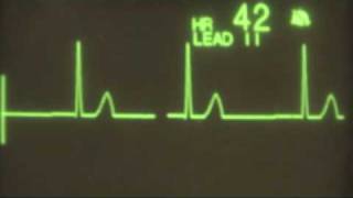 Junctional Bradycardia  ECG Training [upl. by Quincey]