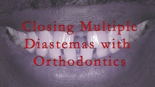 Closing Multiple Diastemas With Orthodontics [upl. by Auhsaj]