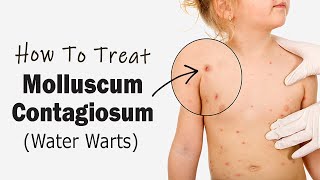 How to Treat Molluscum Contagiosum  Water Warts  Home Remedies for Molluscum Contagiosum Treatment [upl. by Eeuqram]