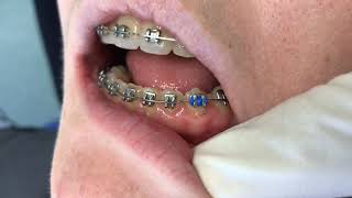 Orthodontic ligation Figure of 8 tie [upl. by Grissom]