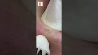 Blackheads Removal  Acne Treatment and Very Satisfying Satisfying Pimple pop blackheads [upl. by Pacifa946]