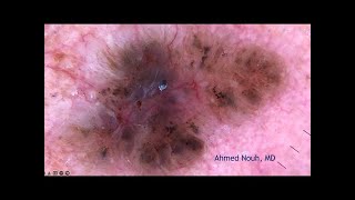 Basal Cell Carcinoma with English subtitles [upl. by Eirek]