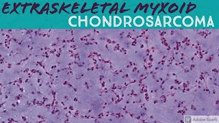 Extraskeletal Myxoid Chondrosarcoma 5Minute Pathology Pearls [upl. by Bala]