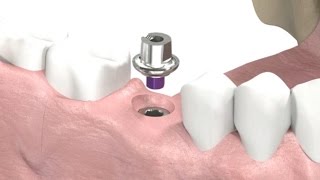 SIC invent Dental Implant  Prosthetic Animation Single Crown Closed Tray Technique [upl. by Salkcin]