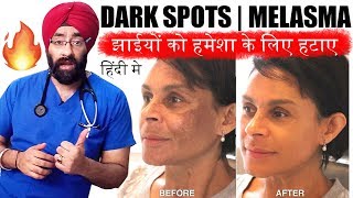 Permanently Cure DARK SPOTS झाइयां MELASMA HYPERPIGMENTATION or BLACK MARKS ENG SUBTITLES [upl. by Nwadrebma]