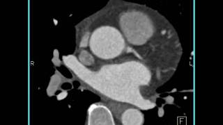 Cardiac Normal aortic root 1 of 3 [upl. by Gerge364]