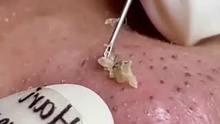 Nose Perfection Popping Giant Blackheads Up Close [upl. by Stanislaw520]