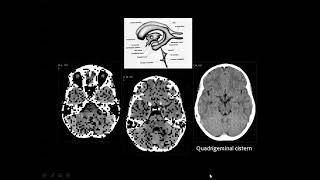 CT brain amp CVS [upl. by Sheffie766]