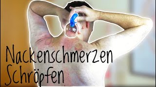 Nackenschmerzen mittels Schröpfen selbst behandeln  Dr Achim Kürten [upl. by Aztiram]