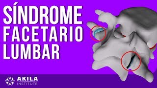 Síndrome facetario lumbar tratamiento efectivo y rápido DESDE LA RAÍZ [upl. by Nossyla149]