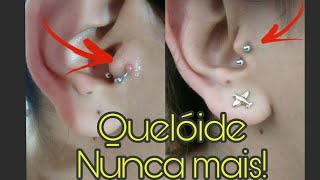 Granuloma no tragus nunca mais [upl. by Seagrave49]