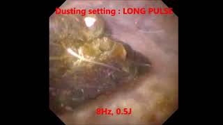 Laser Lithotripsy  Laser Kidney Stones  Setting Demonstration  Sydney NSW [upl. by Orhtej]