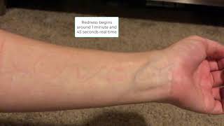 Dermatographia quotskin writing diseasequot timelapse shorts [upl. by Ardnoel]