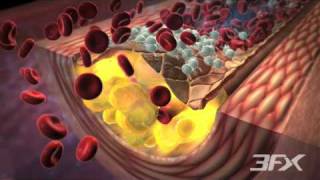 DiabetesRelated Atherosclerosis [upl. by Etterual]