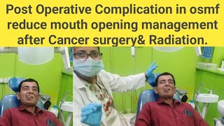 Post Operative Complication in osmf reduce mouth opening management after Cancer surgeryamp Radiation [upl. by Ashby734]