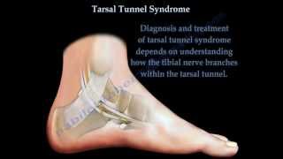 Tarsal Tunnel Syndrome  Everything You Need To Know  Dr Nabil Ebraheim [upl. by Nosduj818]