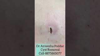 Cyst Removal in Gurgaon For an appointmentCall on 8875865077 or visitwwwdranweshapoddarcom [upl. by Rogerg503]