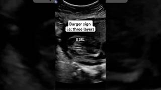 Ultrasound report Baby Boy or Girl 12 weeks Gender Reveal 🤗 shorts ultrasound sonography [upl. by Frear]