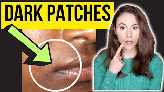 Dermatologist Explains Dark Patches Around The Mouth [upl. by Selin]