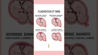 4 Types of twins medically Twin pregnancies pregnant youtubeshorts twins September 4 2024 [upl. by Inattirb468]