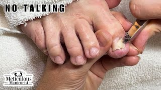 Tricky Ingrown Toenail Trim ASMR nails satisfying asmr [upl. by Scales56]