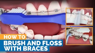 How to Brush amp Floss with Braces [upl. by Ailene]