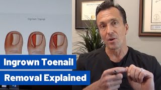 Ingrown Toenail Removal Dr Moore Explains the Permanent Cosmetic Procedure [upl. by Davidde]