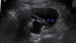 On Call USG  Dr Sanjeev Mani  URINOMA  SUBCAPSULAR  PERINEPHRIC COLLECTIONS  ACUTE RENAL COLIC [upl. by Derron]