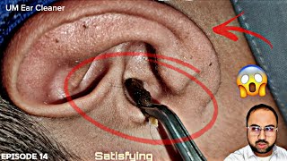 Really Big Ear wax Removal  Ear Cleaning  earwaxremoval  Episode 14 [upl. by Ayahs]