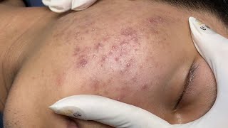 ACNE TREATMENT VU QUYNH MI Acne On Boys Cheek 2024 [upl. by Lednor853]