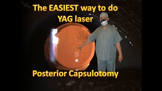 What is the EASIEST way to do YAG laser posterior Capsulotomy [upl. by Cy]