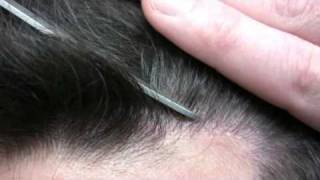 Dr Hasson Hair Transplant  1750 grafts  1 Hair Transplant Surgery [upl. by Auqinet]