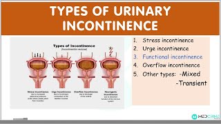 Types of Urinary Incontinence EXPLAINED Stress urge functional overflow incontinence [upl. by Ymarej730]