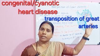 cyanotic heart disease transposition of great arteries [upl. by Adnilreb]