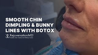 Botox for Chin Dimples and Bunny Lines [upl. by Hubie]