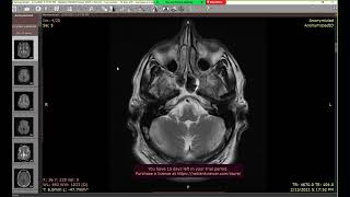 3rd quot Squot sulci extra axial lesions part 2 [upl. by Pomeroy]