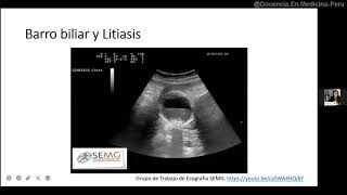 Vesícula biliar Ecografía normal y con litiasis [upl. by Wilma]