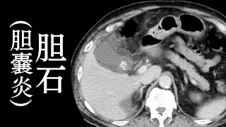 第９回：胆石（胆嚢炎） 胆石（胆嚢炎）の画像診断（CT  MRI） [upl. by Ohce327]