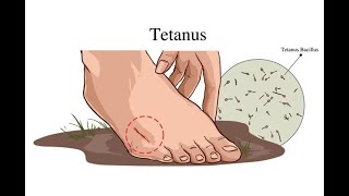 Portals of Entry of Tetanus Clostridium Tetani [upl. by Atnoek843]