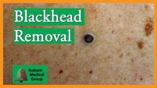 Large Blackhead Removal without Extractor Tool  Auburn Medical Group [upl. by Nonohcle]