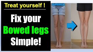 Bowed legs fix Simple bowed legs exercise correction [upl. by Nolaj591]