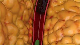 Peripheral Thrombectomy Animation [upl. by Eppes683]