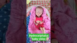 hydrocelphalus baby videohydrocephalus treatment without surgeryhydrocephalus [upl. by Stannwood]