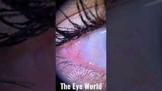 conjunctival cyst [upl. by Octavius480]