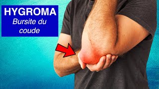 Bursite du coude Hygroma  Symptômes diagnostic et traitements [upl. by Hanad]