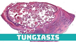 Tungiasis Sand Flea Under the Microscope Tunga penetrans aka jigger flea skin pathology [upl. by Ainolopa536]