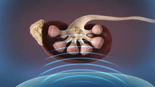 Kidney Stones Shockwave Lithotripsy SWL [upl. by Goles946]