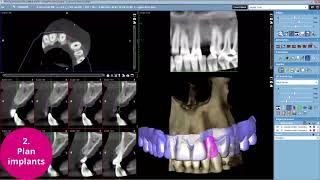 Planmeca Romexis – the complete dental implant workflow [upl. by Eah]