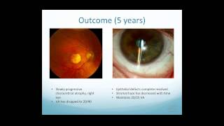 Scleral Lens Indications [upl. by Eniksre29]