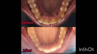 lingual papillary enlargement [upl. by Ardnoel]